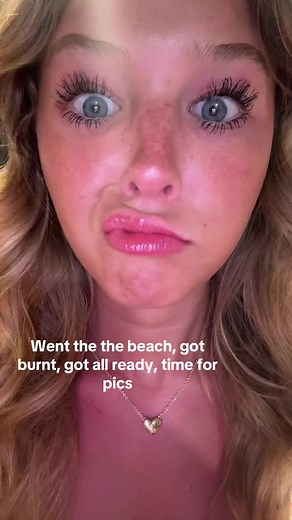 Beach Trip Gone Wrong: Sunburn & Photo Fails