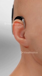 3.4K views | How cochlear implants work (3D Animation) #doctor #documentaryphotography #DoctorWho # reel # shorts #DoctorWh#doctor | SMART Doctor | Facebook