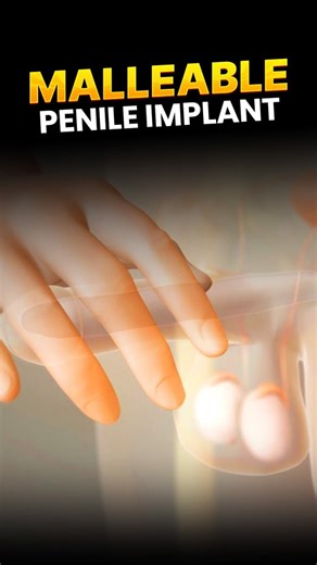SCI Hospital on Instagram: "Let’s talk openly about something most men hesitate to discuss — ED (Erectile Dysfunction) and its solutions. 💬👀 If medications, injections, or therapies haven’t worked… a malleable penile implant can be a life-changing option. This animation shows exactly how the implant works — simple, flexible, safe, and designed to restore confidence, intimacy, and quality of life. 🔧⚕️ No confusion, no awkwardness — just clear, evidence-based information. So many men suffer in