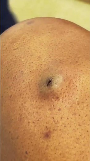 Infected cyst😨 #pimple #extraction #popping #skincare #cyst #whiteheads #blackheads