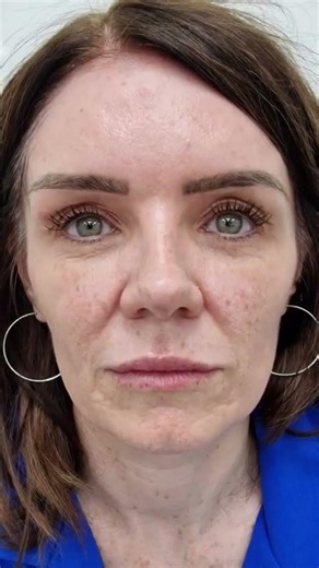 REAL RESULTS from a Liquid Facelift 10 Years Later!