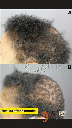 Central Centrifugal Cicatricial Alopecia Restoration