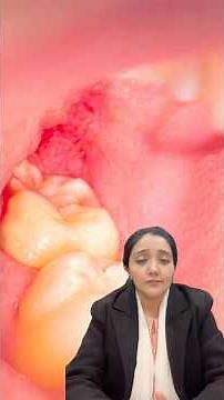 Gum Removal Surgery for Wisdom Tooth | Pain Relief & Benefits Explained