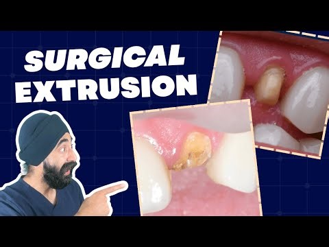 Surgical Extrusion Technique Update - Alternative to Ortho Extrusion or CLS - PDP249
