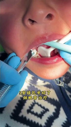 A 5-year-old baby's milk teeth are filled for root canal treatment