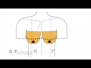 Markings of Breast Reduction Mammaplasty