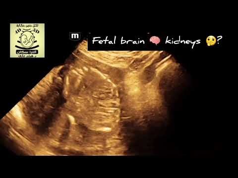 Fetal brain 🧠 kidney 🤔? Follow the hashtag #ultrascan_fetal_ultrasound_school
