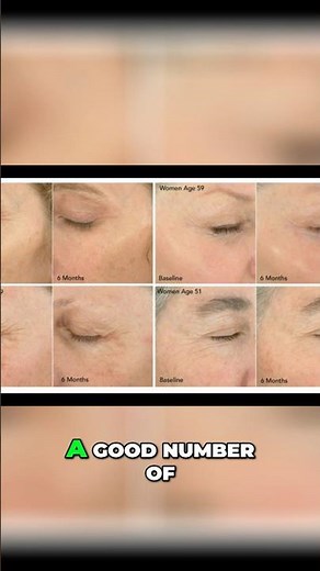 Shocking Truth About TNS Growth Factor Serum Results #cosmeticdermatology