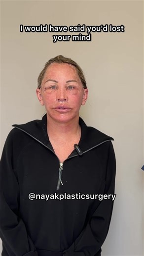 Kristie's Omakase Facelift Journey: Day 2 Recovery