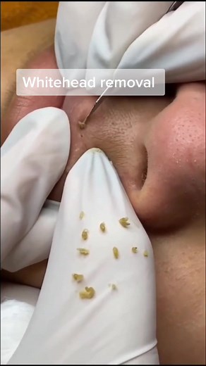 Whitehead removal #satisfying #beautcare #sinkclean #extractions @Ahoufe @TikTok Nigeria