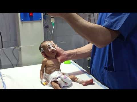 NG Feeding Procedure in Hospital | Clinical Practice