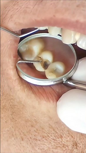 Emergency Extraction: Removing a Split Tooth