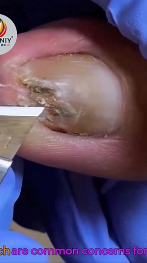 Easy Routines That Help Thick Toenails That Can Be Done Daily #FootCareTips #ThickToenailCare #HomeNailCare #SafeNailCare | Evgeniy