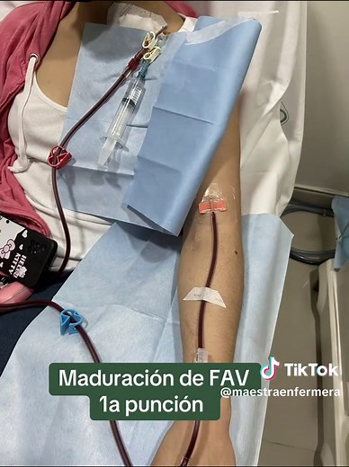 Catéter de Hemodiálisis: Proceso y Maduración de FAV