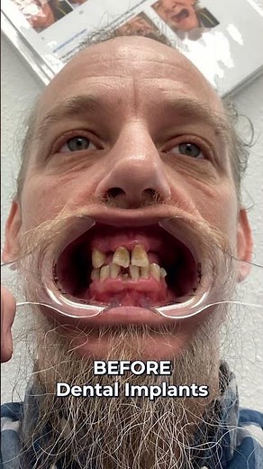 Before And After Smile Transformation! 🤯 Full Mouth Dental Implants! 🦷✨ #shorts