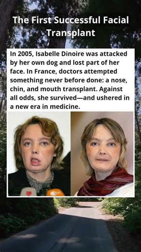 The First Successful Face Transplant