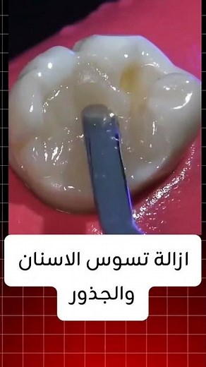 ازالة تسوس الاسنان والجذور #معلومات #تجميلاسنان #طب #التهاب #تجميل #dentist