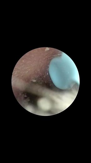 Explore the Fascinating World of Ear Cleaning Cameras