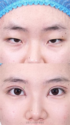 Dr.zhang on Instagram: "The single eyelid is exploded and the double eyelid is changed. After finishing, the eyes are bright, and it is so beautiful. #doubleeyelid #neotenism #eyesynthesis#"
