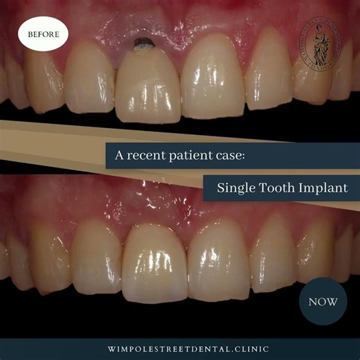 Single Tooth Implant for Front Tooth | Before and After
