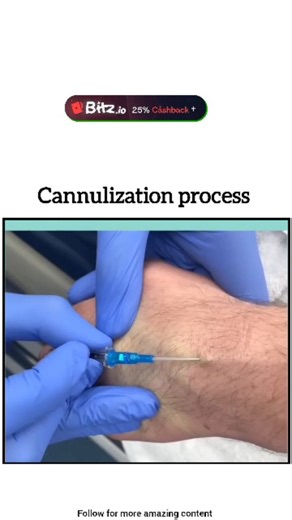 Ak Nursing Academy on Instagram: "The cannulation process involves inserting a small, flexible tube (cannula) into a vein to give fluids/meds or draw blood, starting with patient ID, consent, and tourniquet application; then, after disinfecting the skin, the needle is inserted at a low angle (15-30°) until a blood flashback confirms vein entry, after which the needle is withdrawn, the catheter advanced, secured, and flushed, ensuring sterile technique throughout for patient safety. . . . Only fo