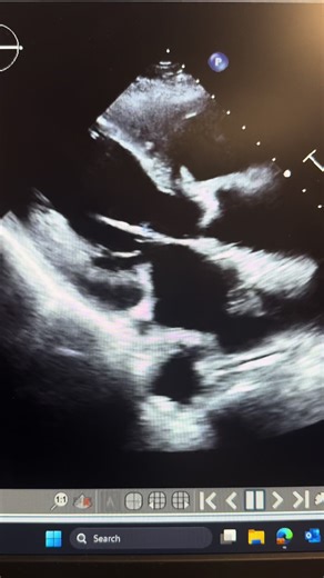 Understanding Sweep Techniques for Sonographers