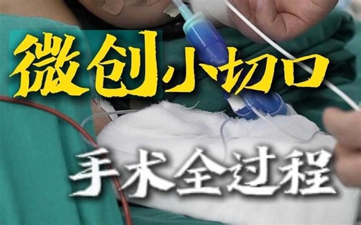微创小切口手术全过程