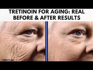 Tretinoin before and after aging