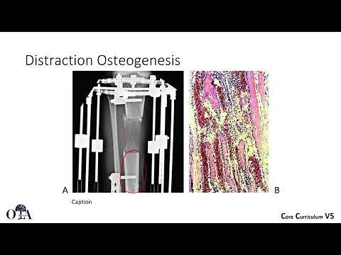 Principles of external fixation - 3 of 3