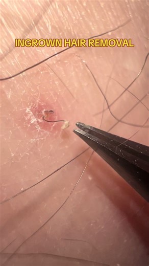 Effective Ingrown Hair Removal Techniques
