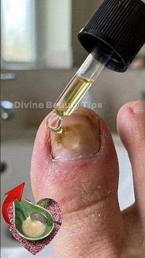 Get Rid of Nail Fungus Naturally! 🌿
