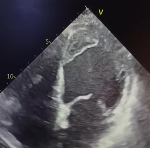 Anteroapical thrombus in patient with anteroapical akinesia post anteroapical MI Why an akinetic area predisposes to thrombus formation 1. Blood stasis (the main reason) An akinetic region does not contract, so it fails to eject blood properly. Blood becomes stagnant in that pocket, especially in the apex → slow-flow / spontaneous echo contrast appears on echo. Slow flow is the perfect environment for clot formation. 2. Endocardial injury after infarction Akinetic segments usually represent an a