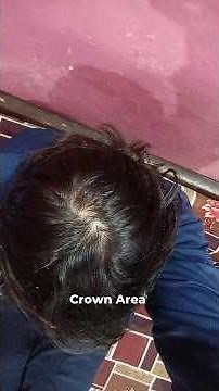 Receding hairline & Crown Area Balding | Budget Haircare Routine for Men