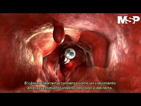 ¿Cómo funciona el cáncer colorrectal? - #ExclusivoMSP