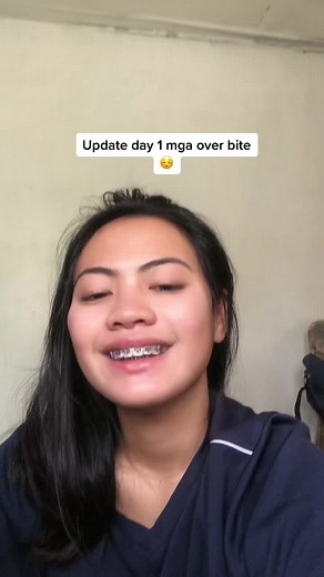 Overbite Braces: Process, Before and After Results