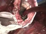 Repair of Aneurysm of the Ascending Aorta  • Video • MEDtube.net