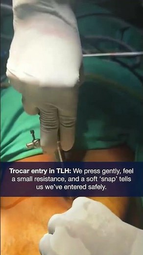 The First Step of Laparoscopic Hysterectomy: Trocar Entry Explained
