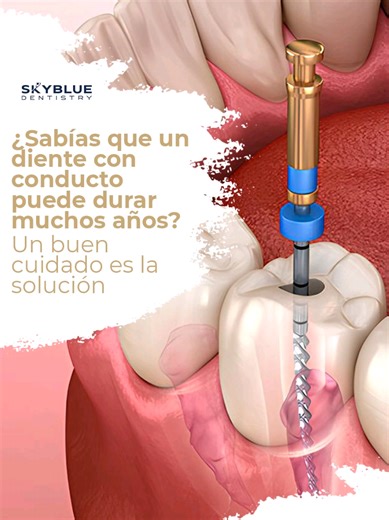 ¿Diente con conducto = Diente perdido? 🤔❌ ¡FALSO! Mucha gente le tiene miedo al tratamiento de conducto (endodoncia), pero aquí te cuento la verdad: 1️⃣ Es una salvación: Es la última línea de defensa para NO perder tu diente natural. 🛡️🦷 2️⃣ Dura por décadas: Si se protege con una corona y lo cuidas bien, ¡puede durar toda la vida! ♾️✨ 3️⃣ Cero dolor: La tecnología actual hace que el proceso sea cómodo y elimine el dolor de raíz. 💉☁️ ¡No dejes que los mitos te hagan perder una pieza dental!