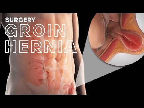 General surgery: Groin Hernia