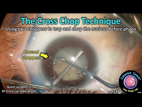 CataractCoach™ 2146: the cross chop technique