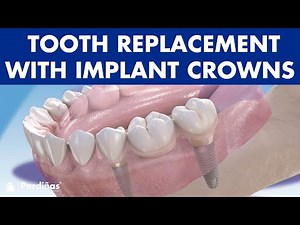 MISSING TEETH? Four solutions for TOOTH REPLACEMENT with IMPLANT CROWNS ©