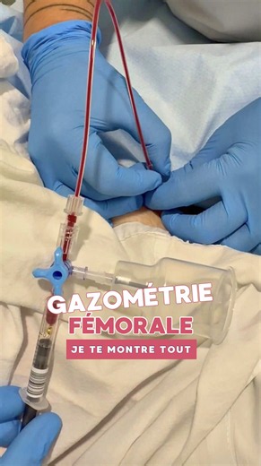 Ton patient est en choc, 6 de tension, et tu dois prélever une gazo ET des hémocs… mais le veineux est impossible 😬 👉 La gazométrie fémorale, le plan B quand la radiale est imprenable. ⚠️ Soin sur prescription médicale, et toujours selon le protocole de ton service. Dans ton service, c'est l'IDE ou le médecin qui prélève en fémorale ? Dis-le-moi en commentaire 👇 #infirmiere #ide #esi #nursingstudent #nursing