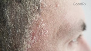 How Do I Tell If I Have Scalp Psoriasis vs. Dandruff? Differences Explained - GoodRx