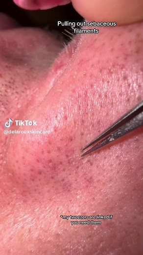 Effective Skincare Tips: Removing Sebaceous Filaments Safely