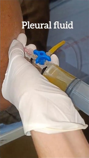 pleural tapping 💉. #medicos #medicalprocedures #internshipdiaries