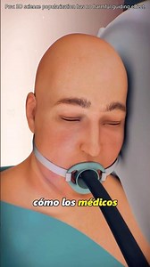 How Incisionless Fundoplication Surgery Is Performed #foryou #3danimation #ytshorts #doctor #us