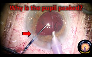 Why is the pupil peaked during this cataract surgery?