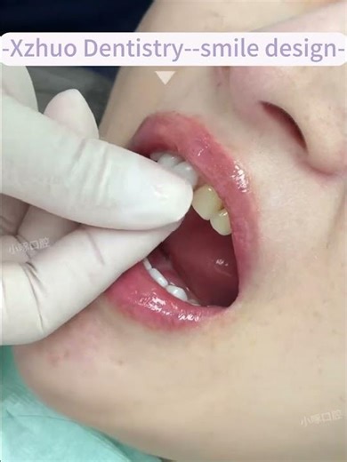 i ruined my teeth in turkey, and got them restored in china? #veneers #turkeytravel #chinatravel