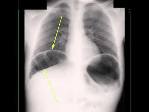 Interposition of colon under right Hemidiaphragm on X ray