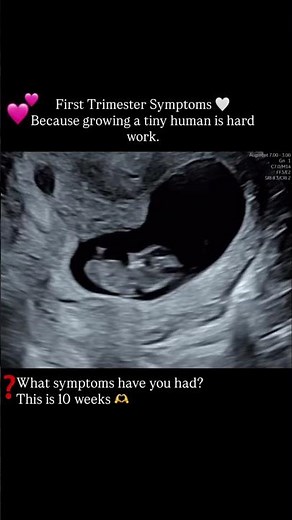 10 Weeks Pregnancy Ultrasound | What We See in 10 Week Sonography | Dr Komal Saini #ultrasound